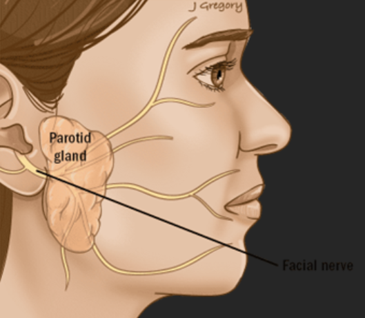 Illustration showing the parotid gland and facial nerve before parotidectomy surgery
